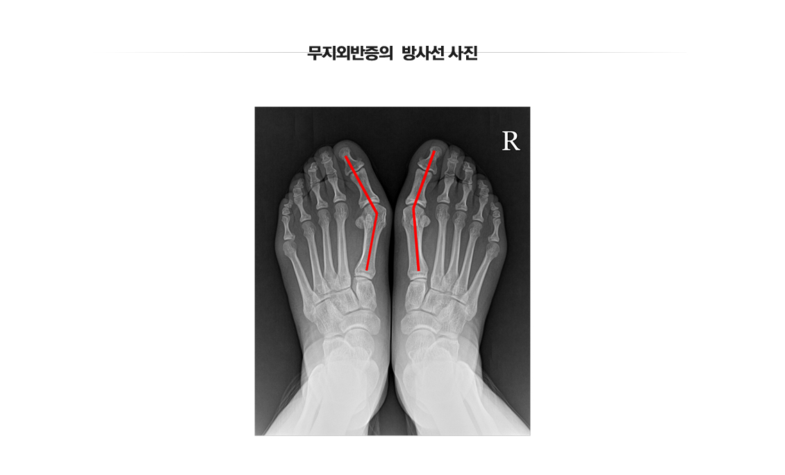 Hallux Valgus