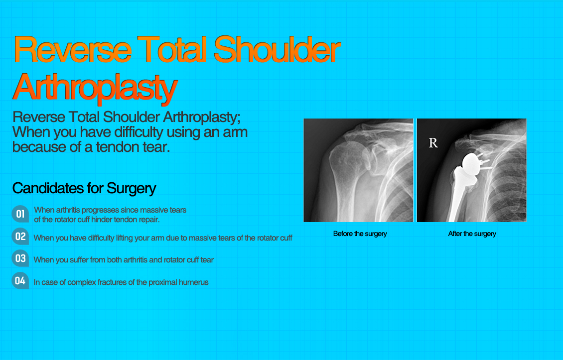 Impingement Syndrome