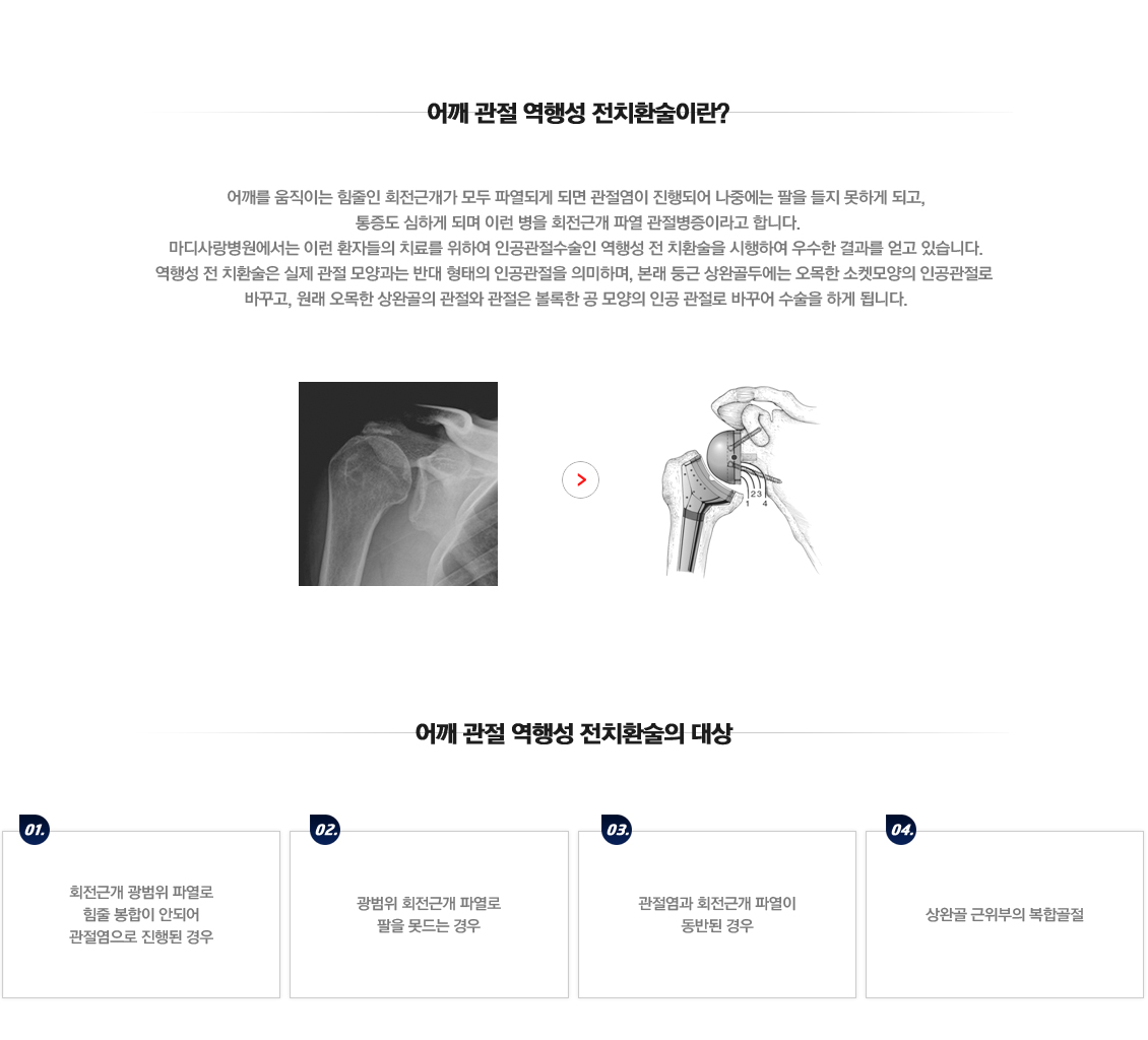 Impingement Syndrome