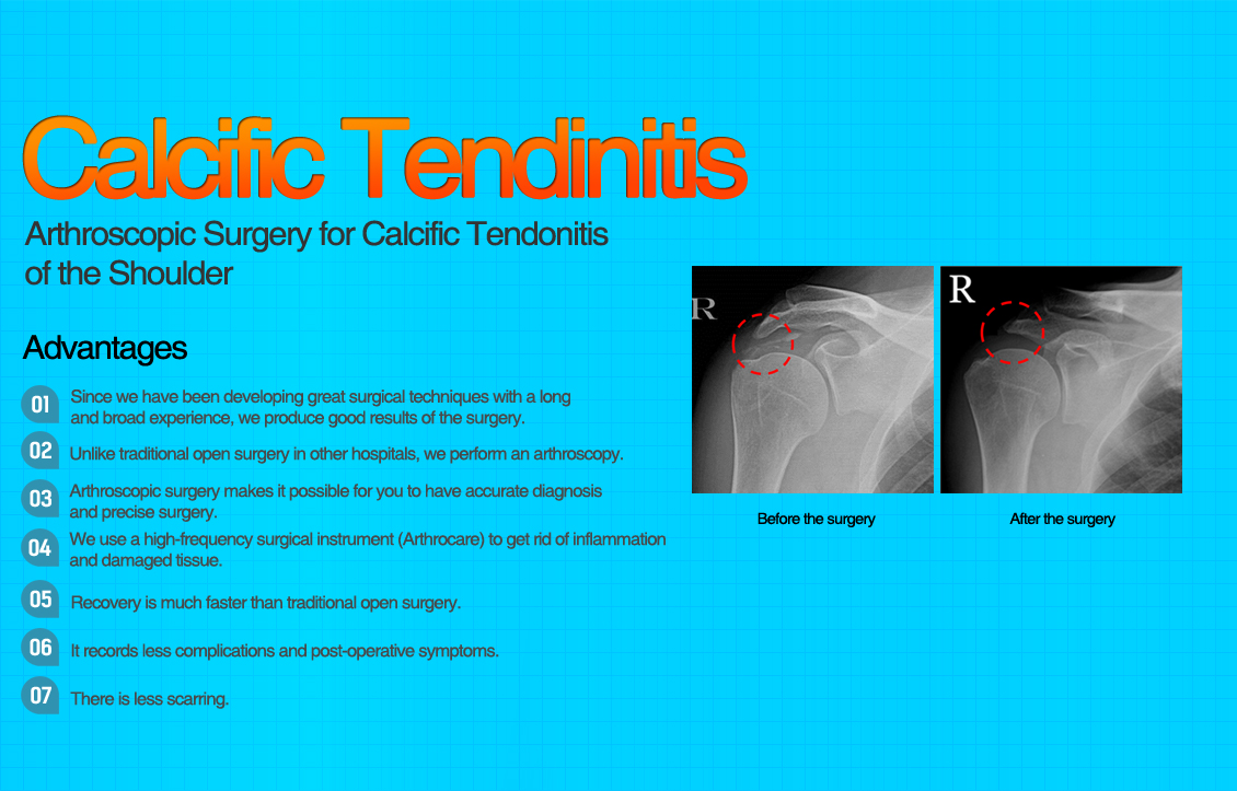 Calcific Tendinitis