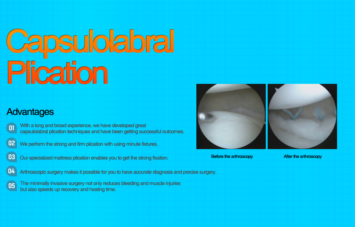 Capsulolabral Plication