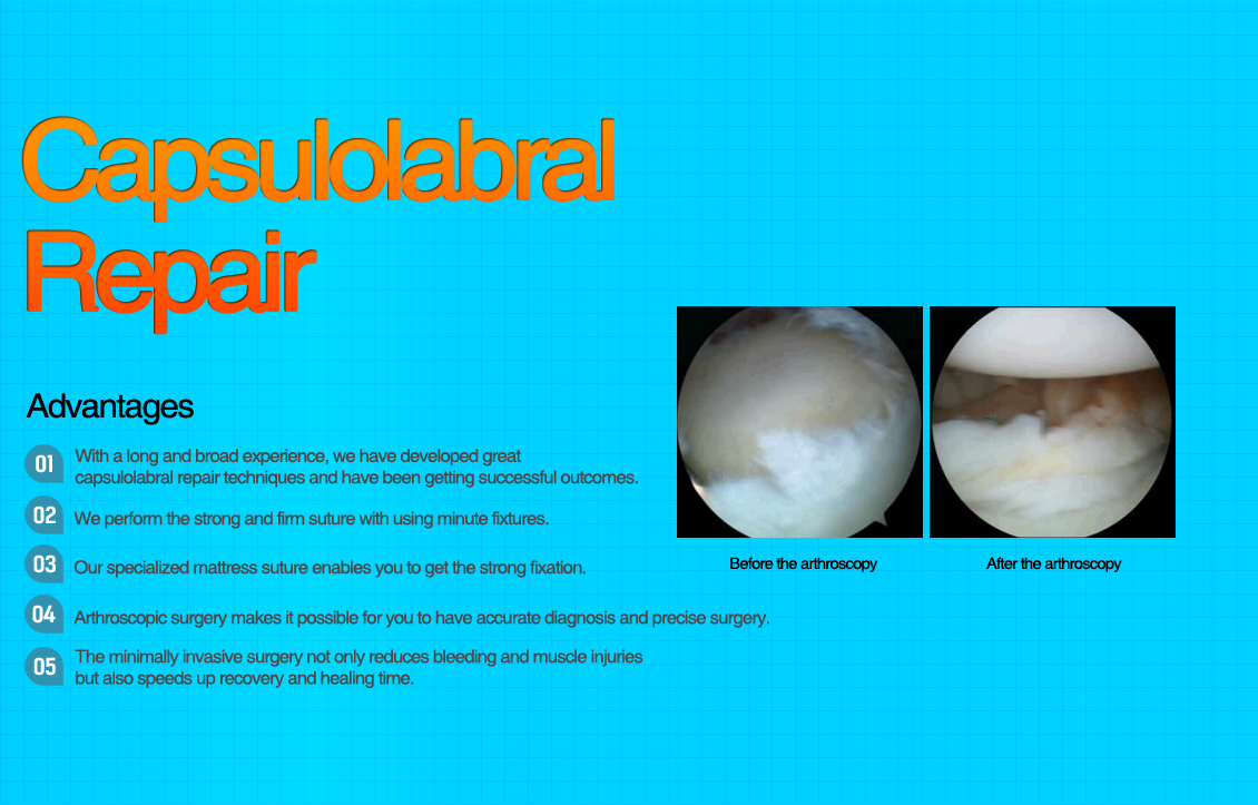 Capsulolabral Plication