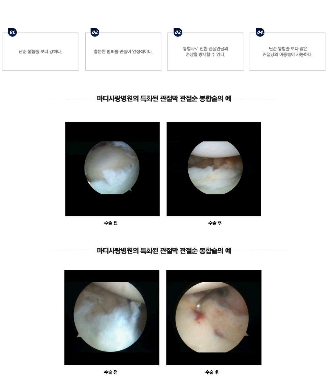 Capsulolabral Plication