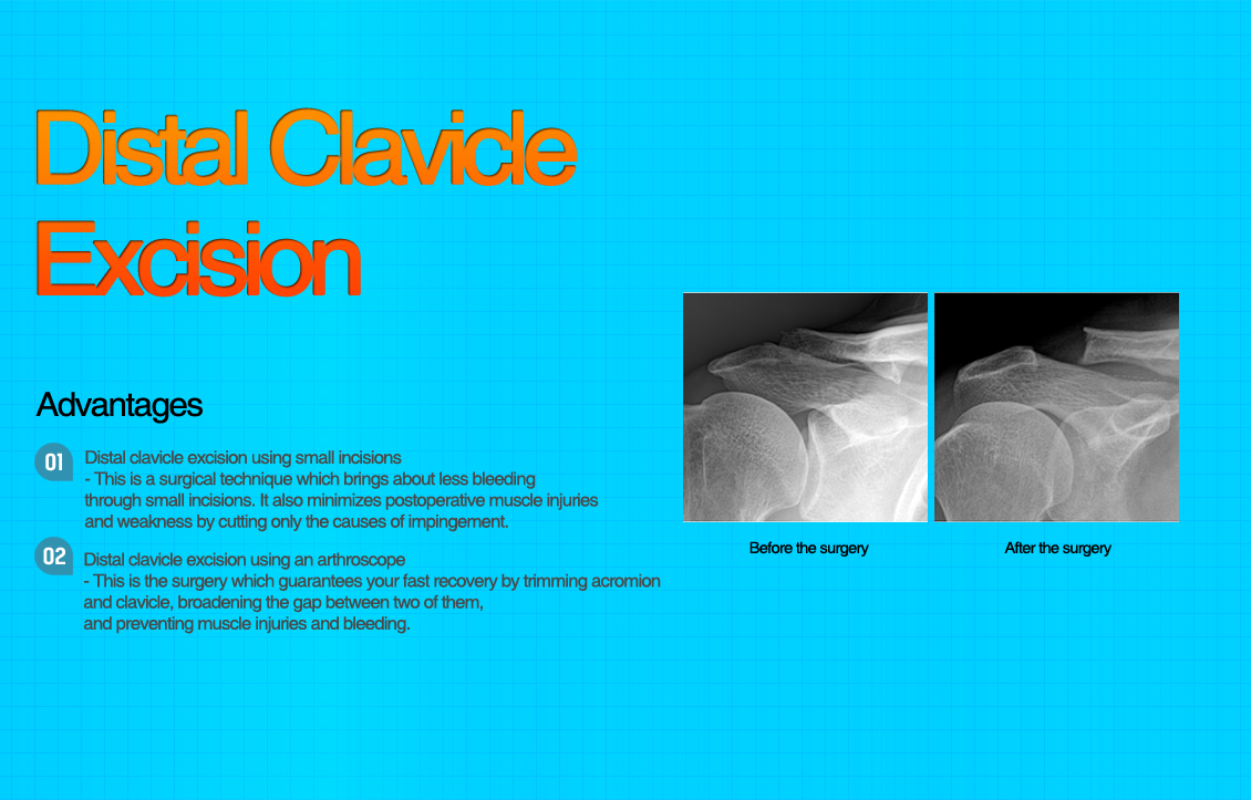 Distal Clavicle Excision