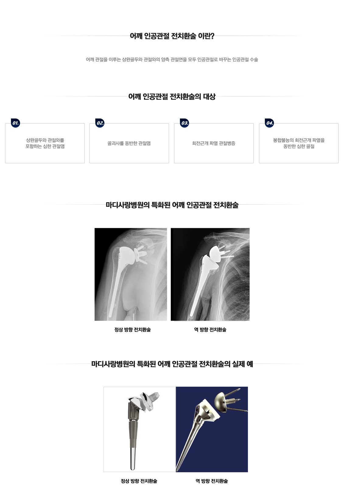 어깨 인공관절 부분치환술