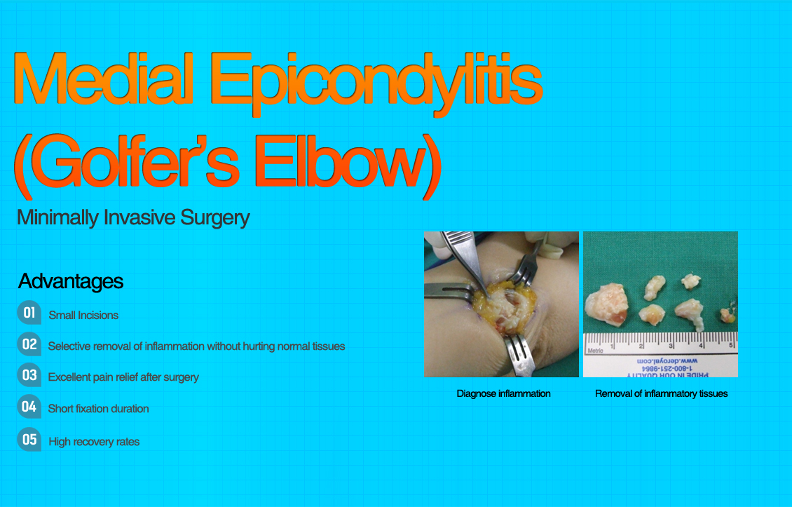 Medial Epicondylitis