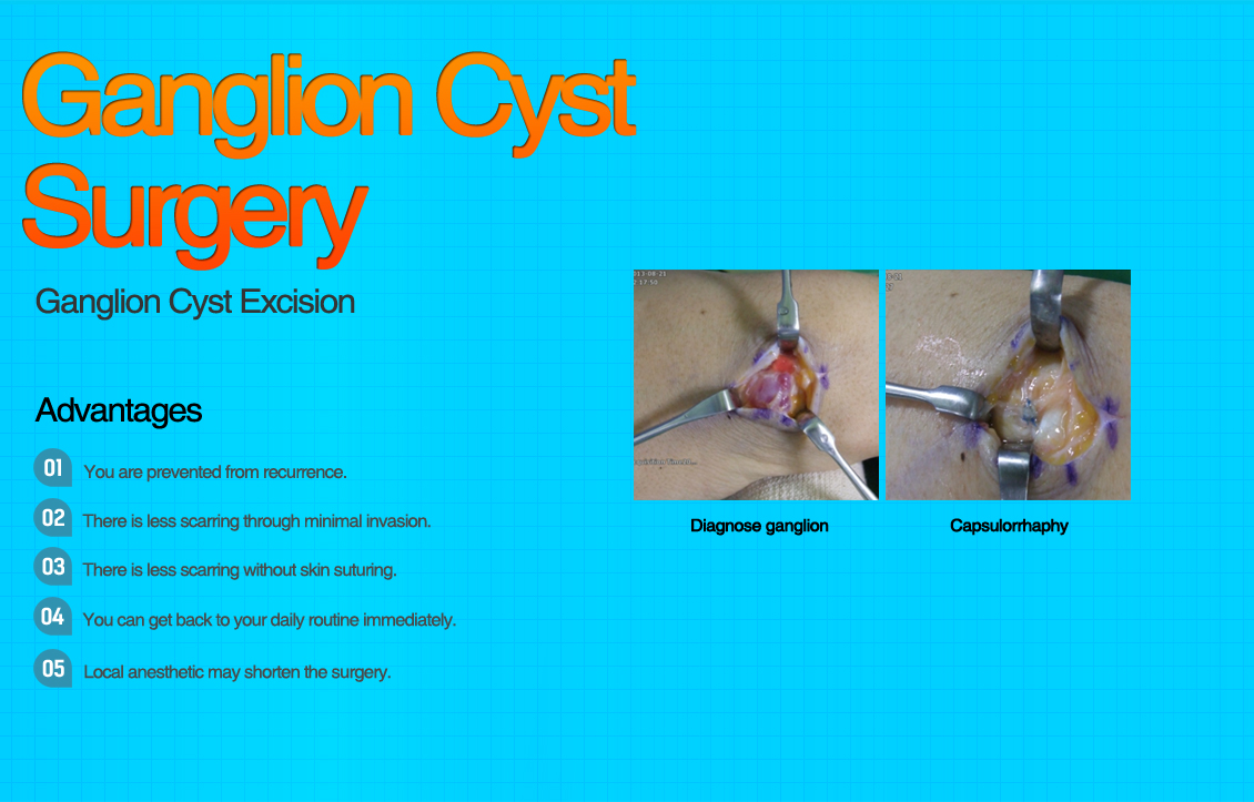 Ganglion Cyst Surgery