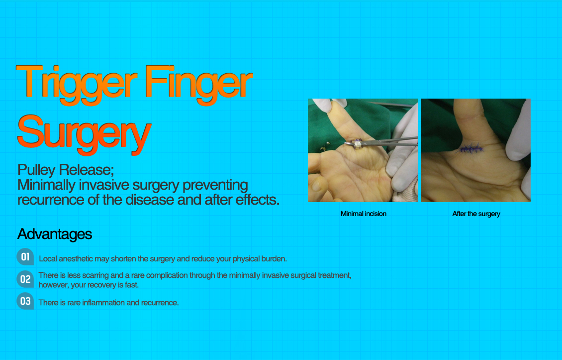 Trigger Finger Surgery