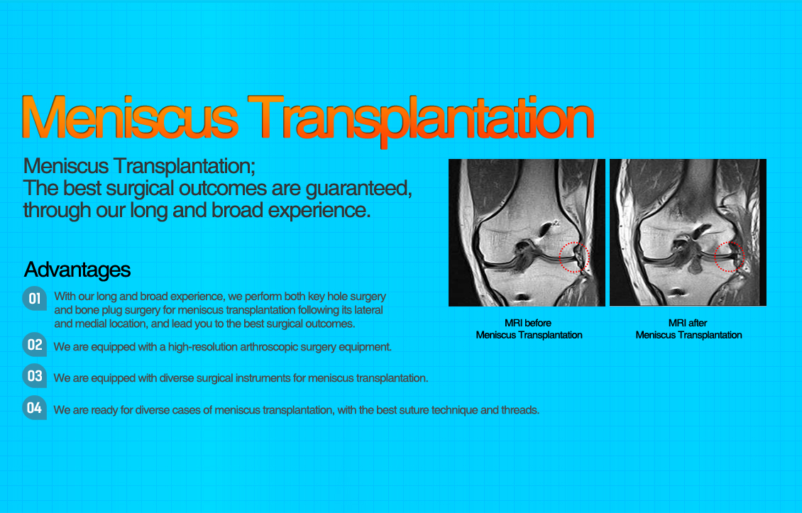 Meniscus Transplantation