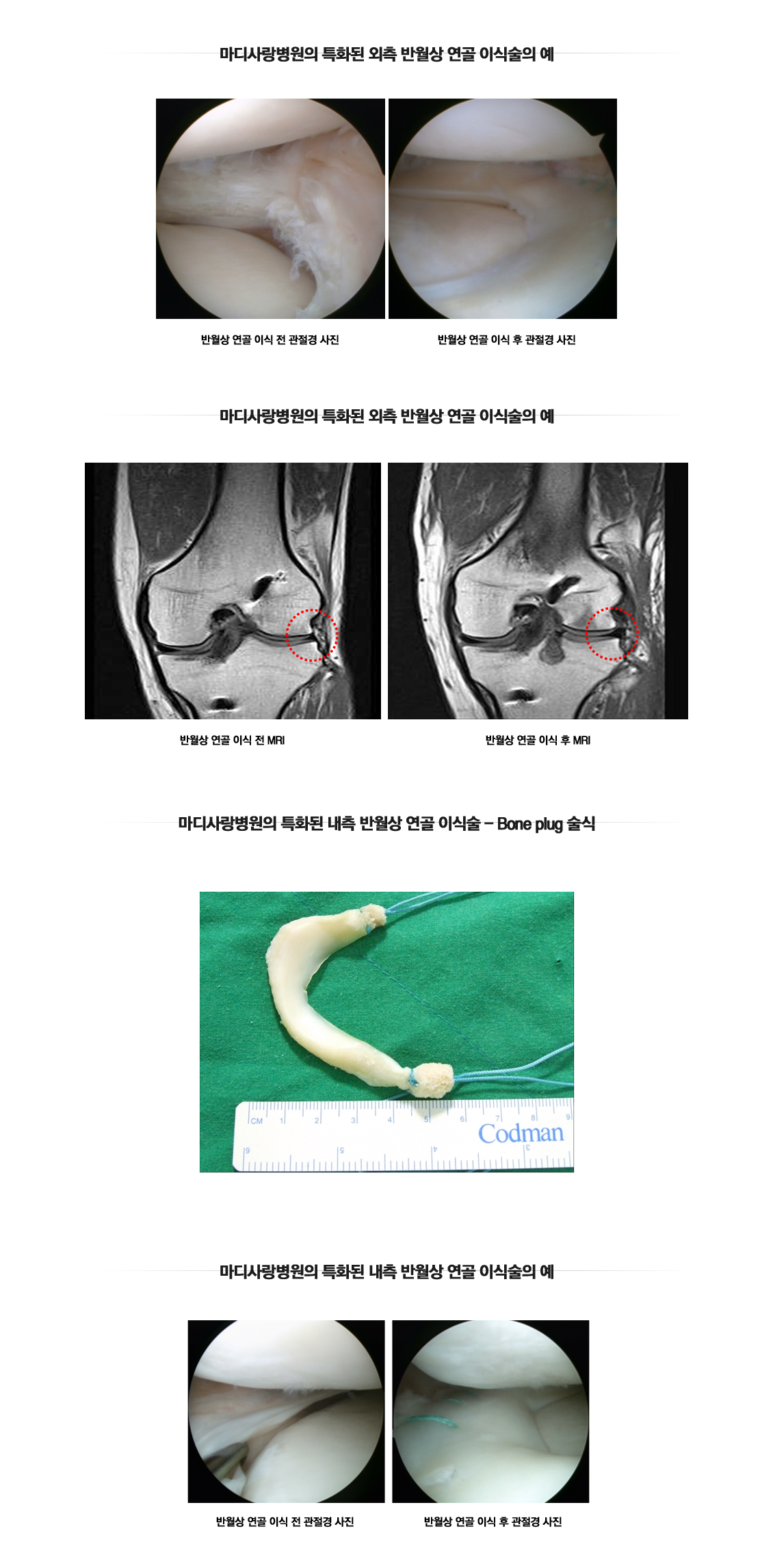 Meniscus Transplantation