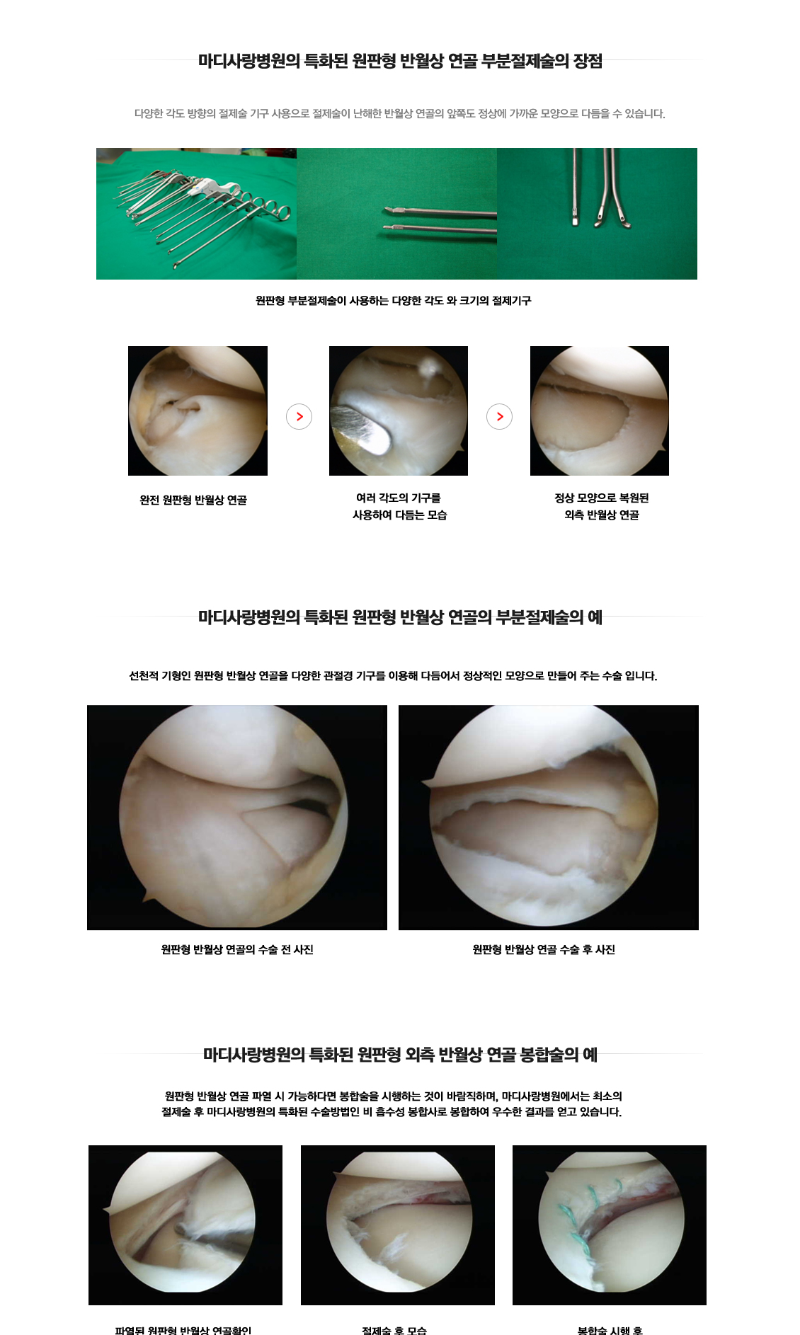 Discoid Meniscus Surgery