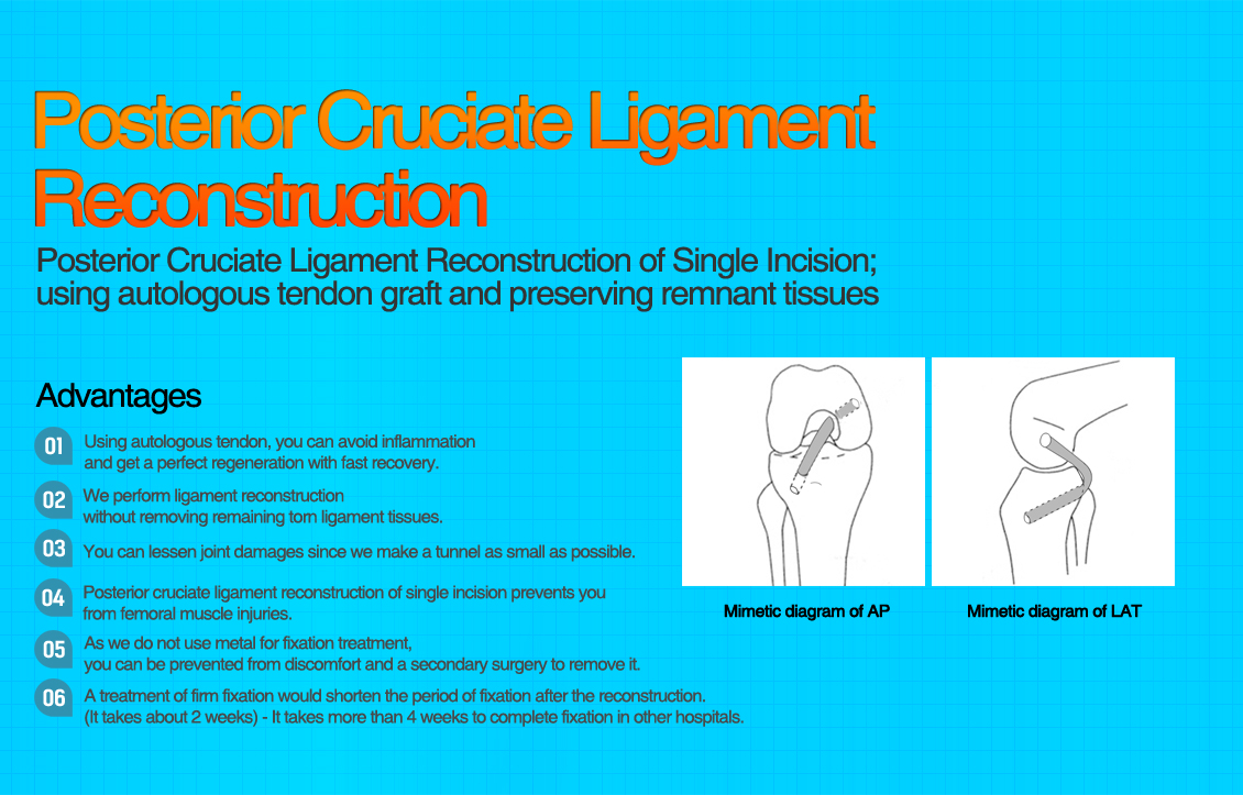 PCL Reconstruction