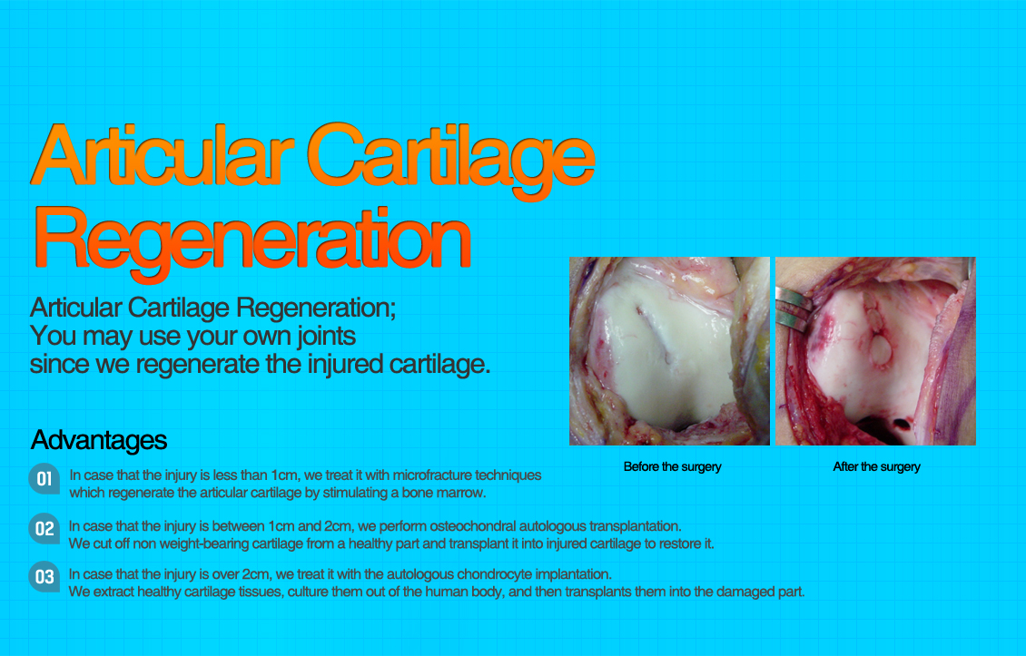 Articular Cartilage Regeneration