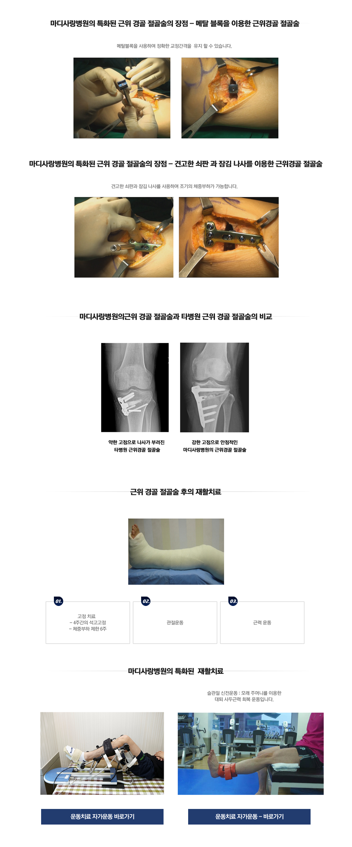 High Tibial Open Wedge Osteotomy