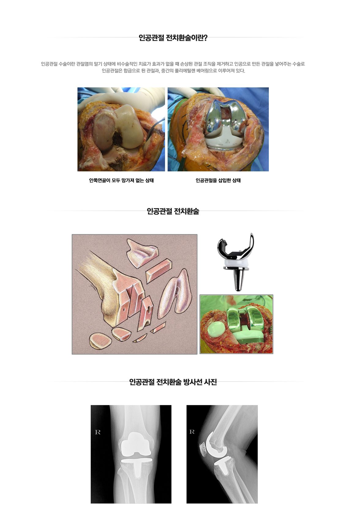 Total Joint Arthroplasty