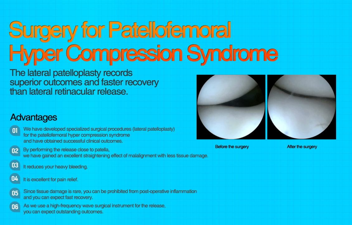Patellofemoral hypercompression syndrome