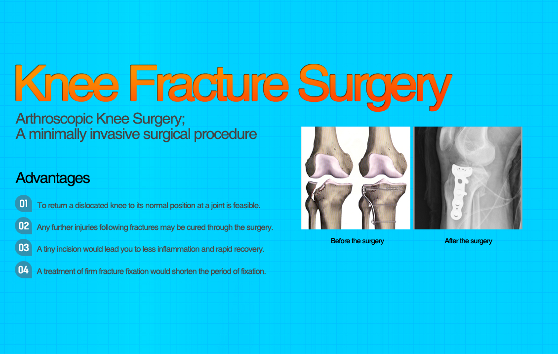 무릎 골절수술