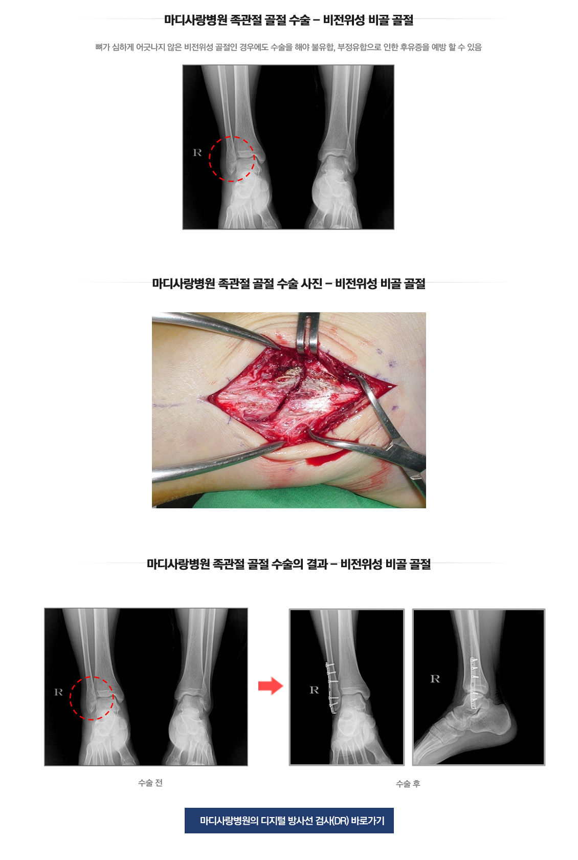 외측불안정성 수술