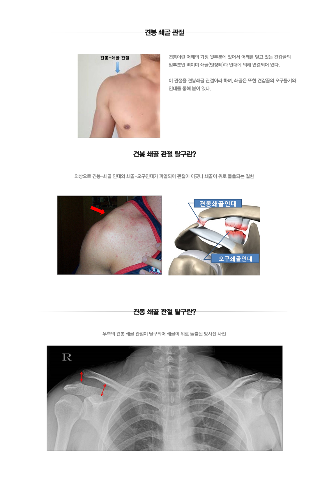 견봉쇄골 관절 탈구