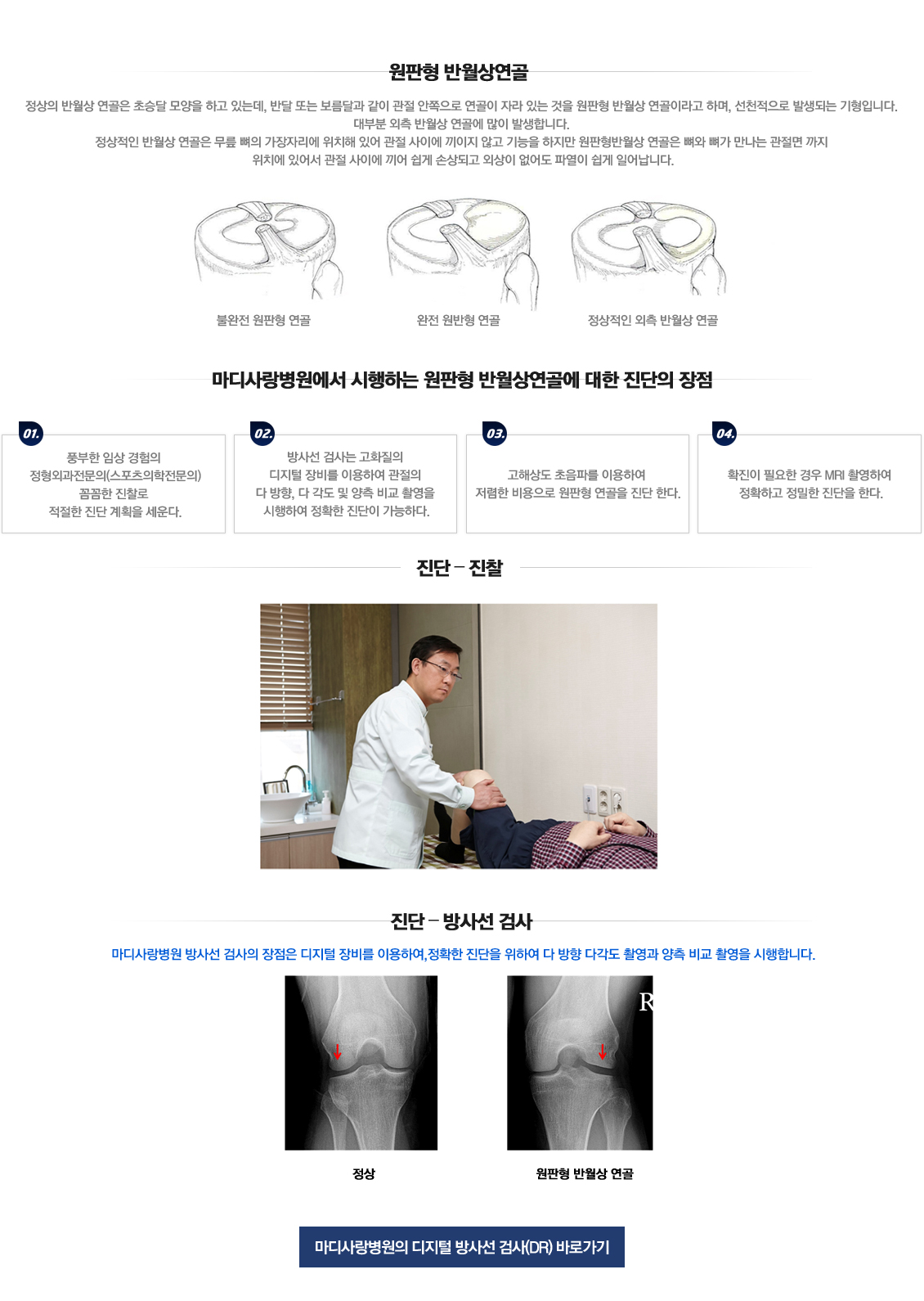 원판형 반월상 연골 파열