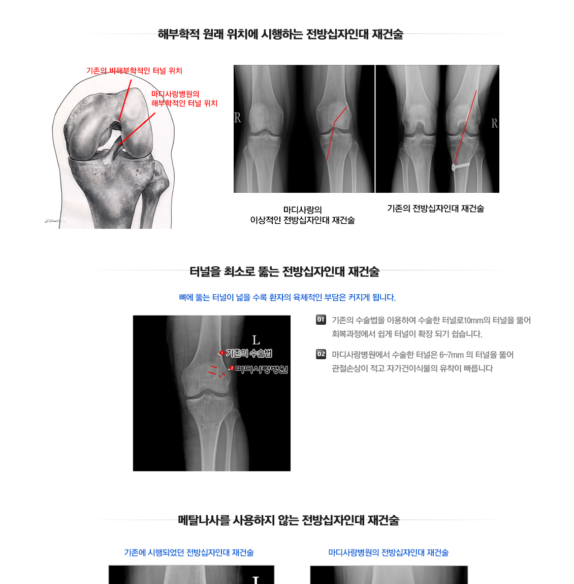 전방십자인대 파열