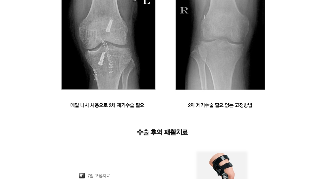 전방십자인대 파열