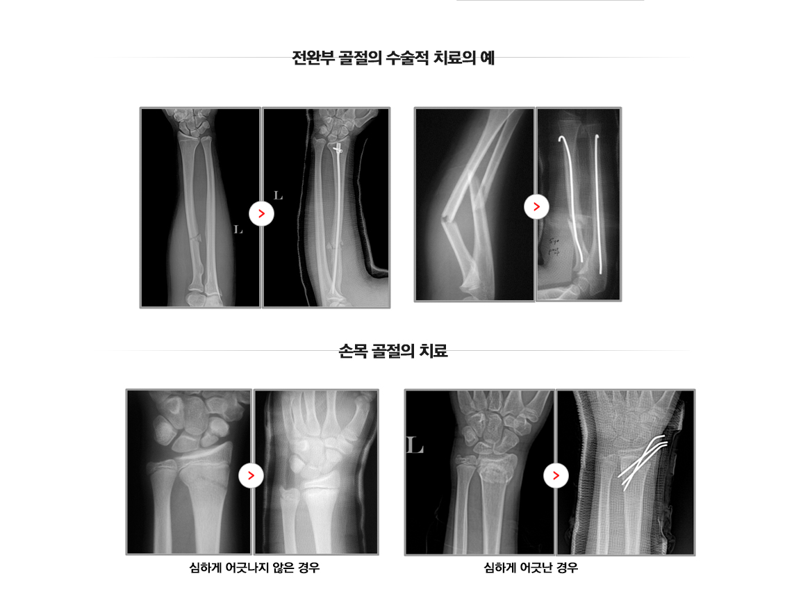 소아 골절