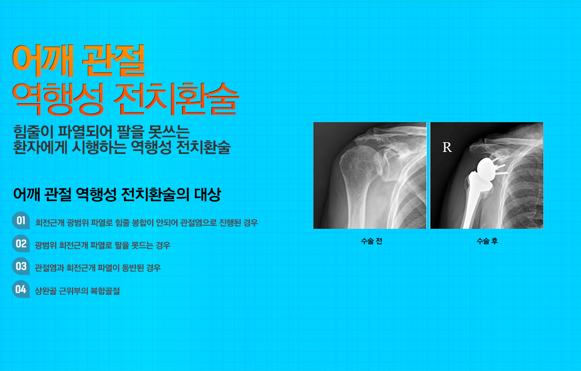 충돌증후군