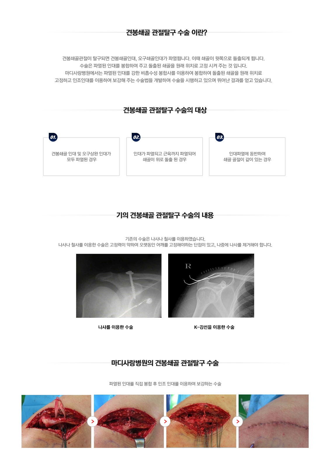 습관성 탈구