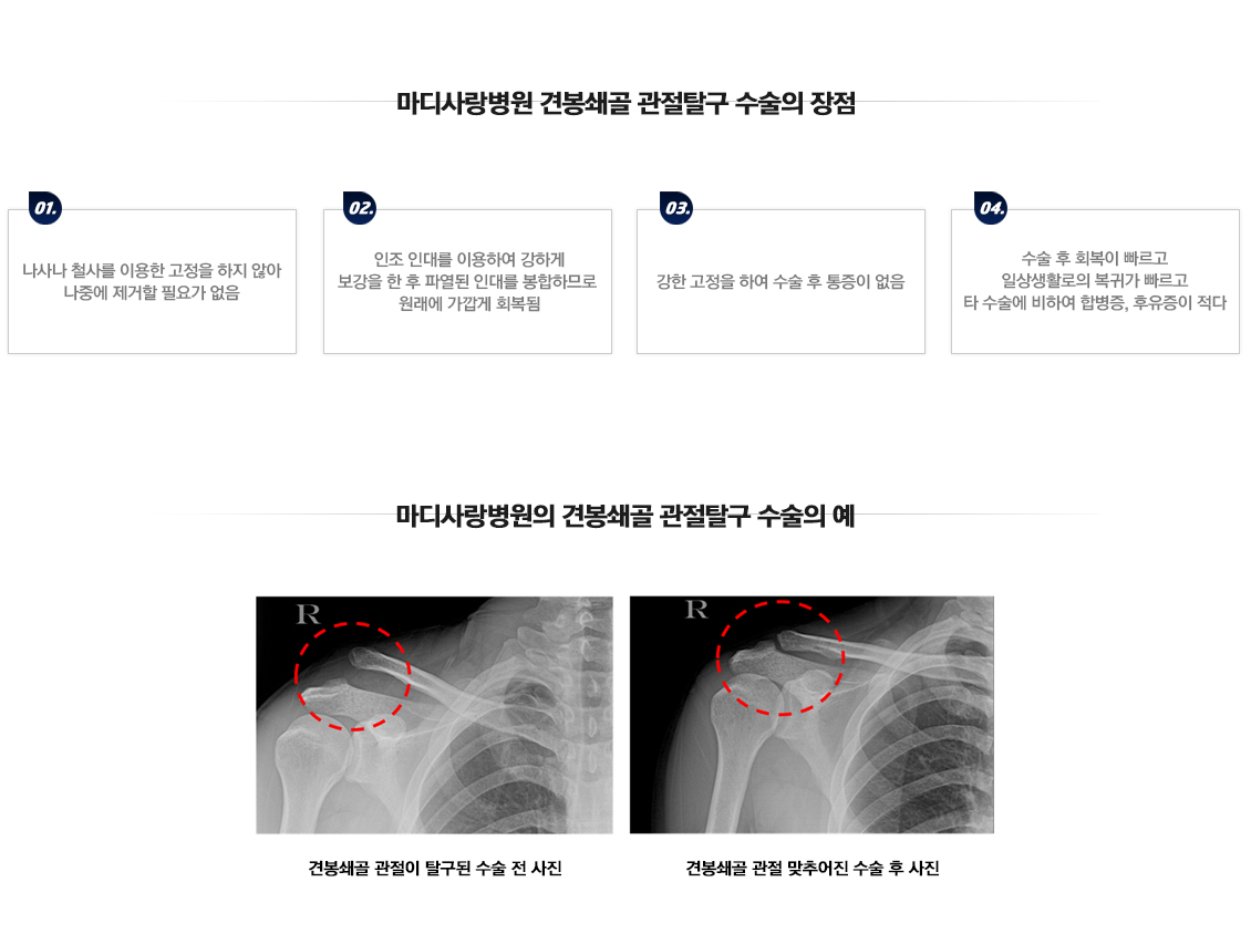 습관성 탈구