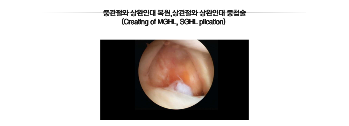 어깨 인공관절