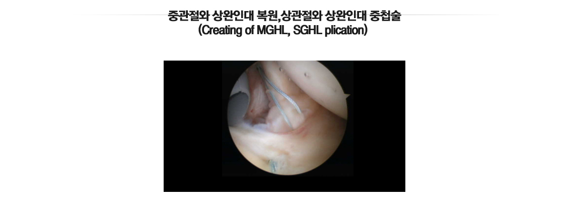 어깨 인공관절