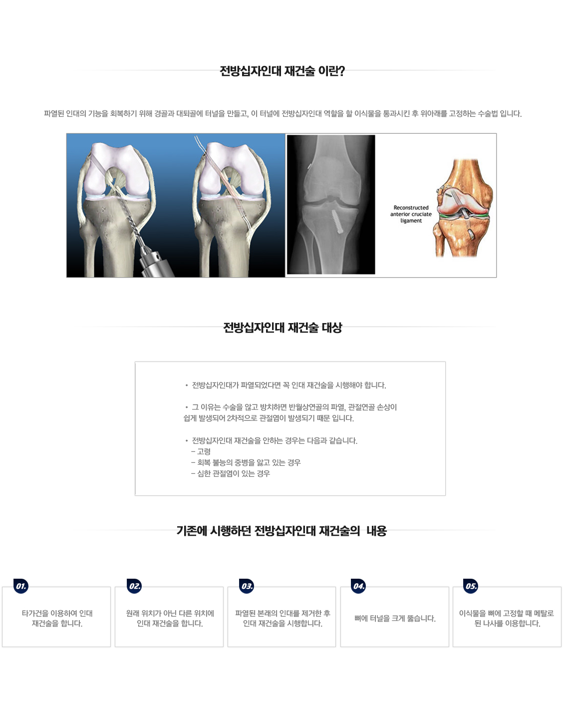 전방십자인대 재건술