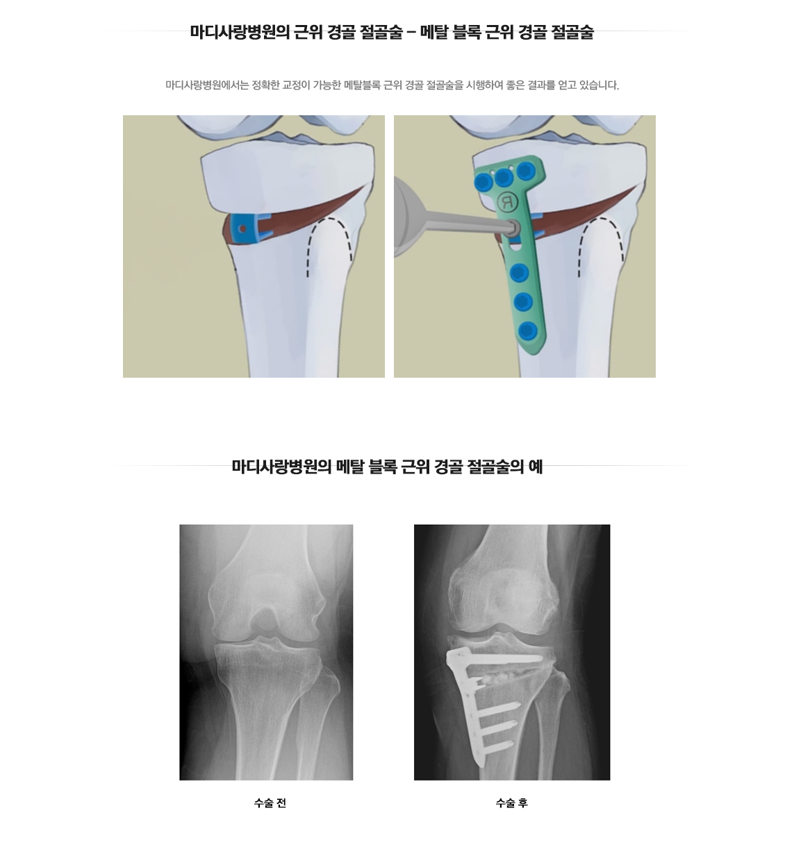 근위경골 절골술