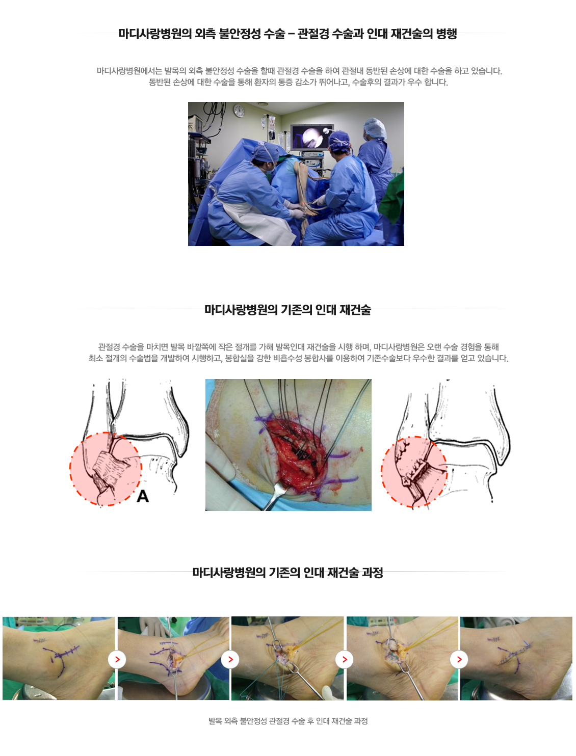 외측불안정성 수술