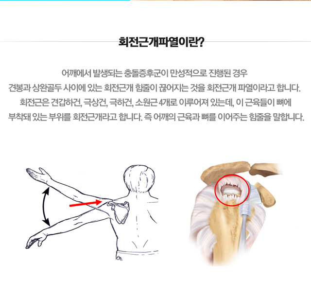 회전근개파열