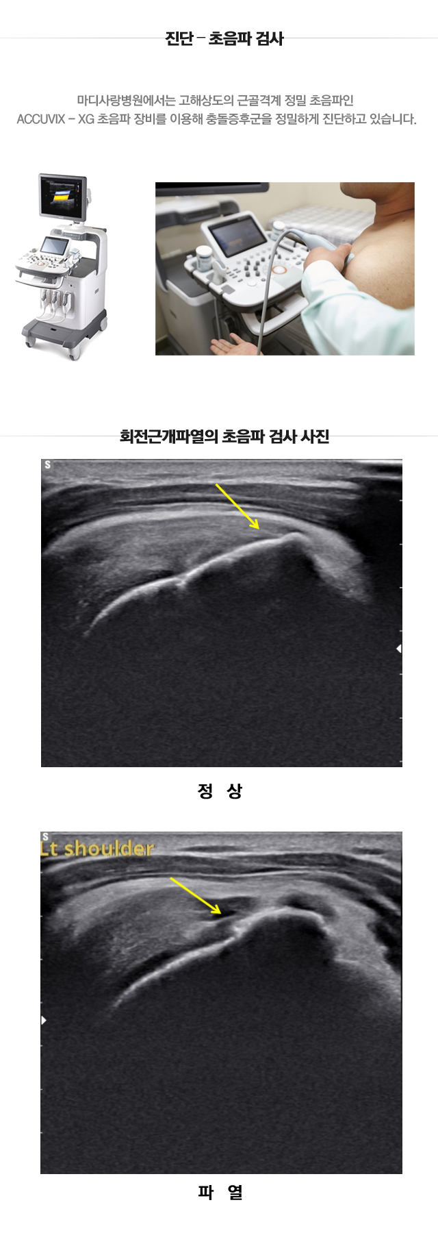 회전근개파열