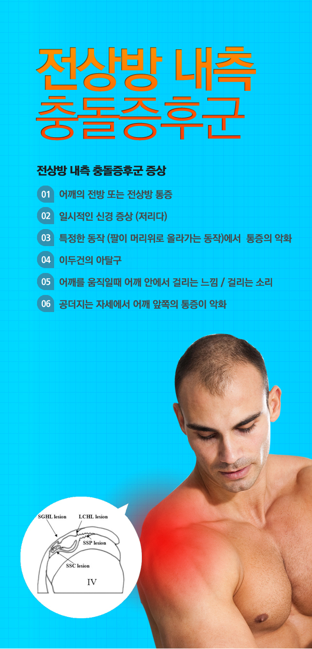 전상방 내측충돌증후군