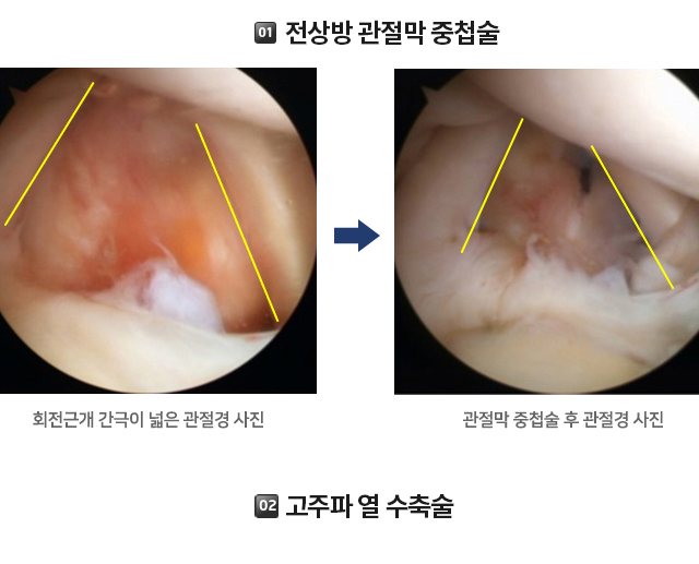 전상방 내측충돌증후군