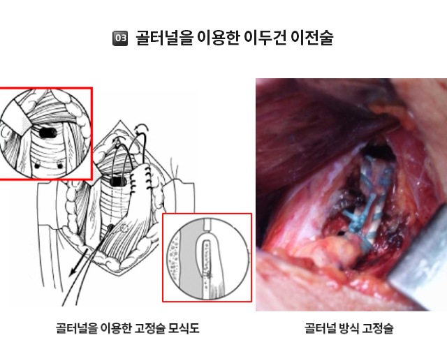 전상방 내측충돌증후군