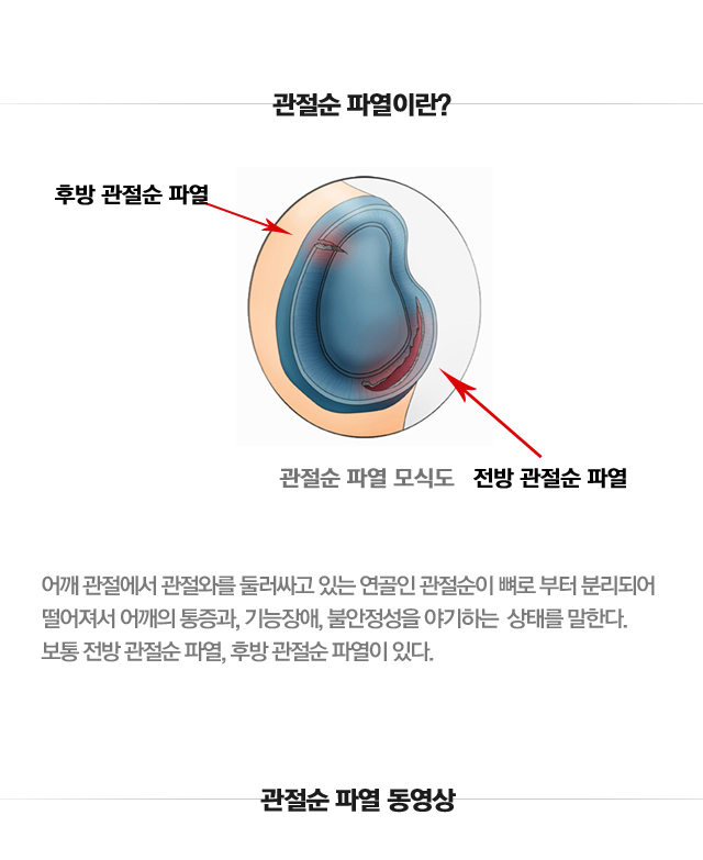 관절순파열