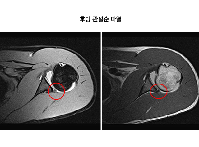 관절순파열