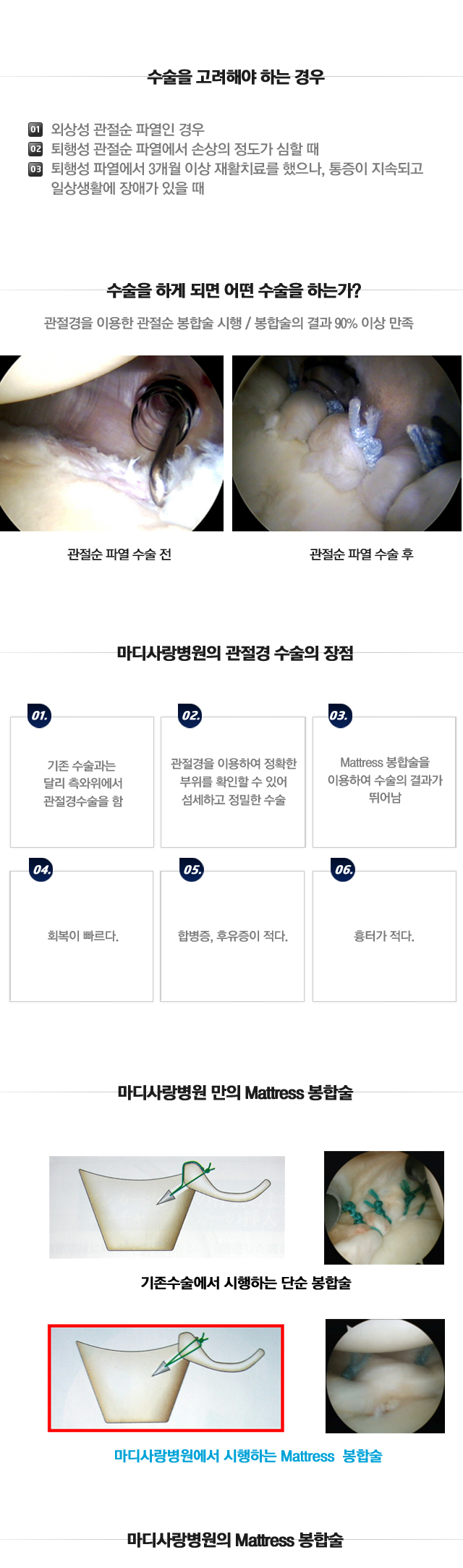 관절순파열