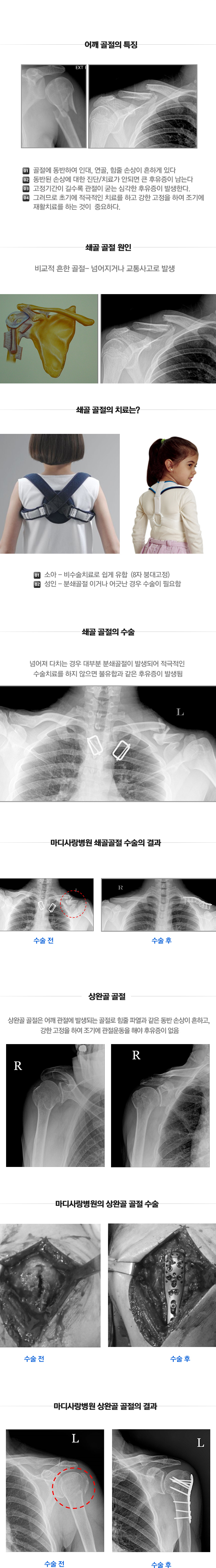 어깨 관절의 외상