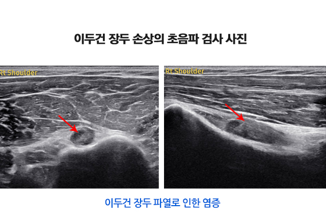 이두건 장두 손상