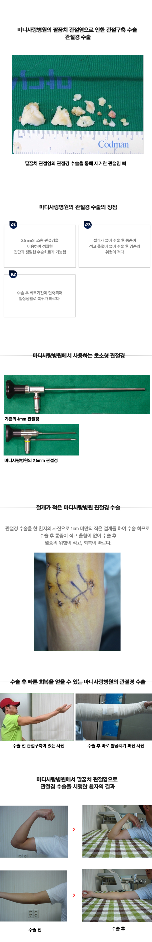 팔꿈치 관절염