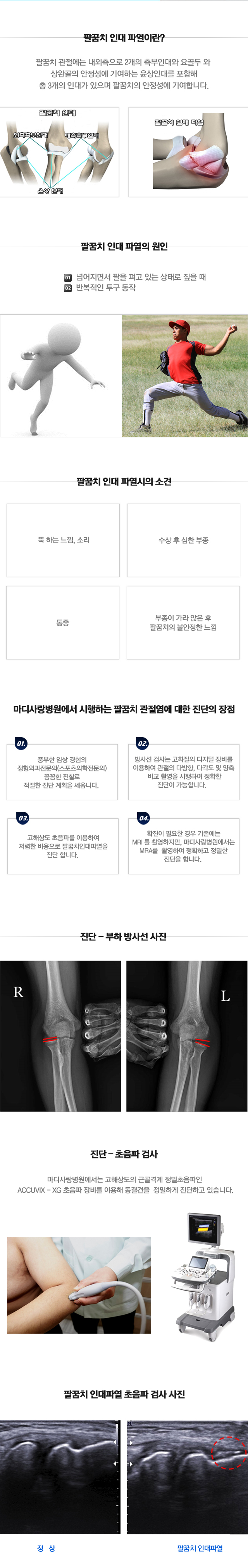 팔꿈치인대파열