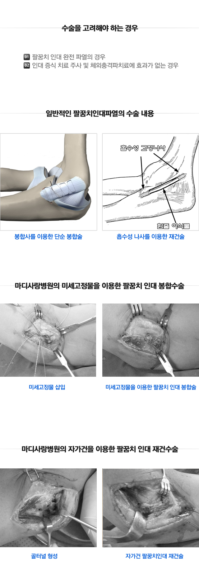 팔꿈치인대파열