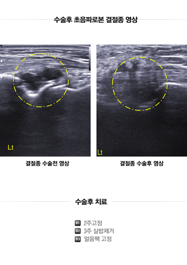 척골충돌증후군