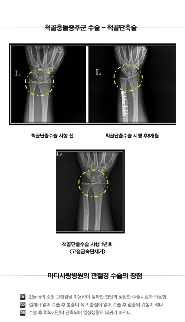 척골충돌증후군